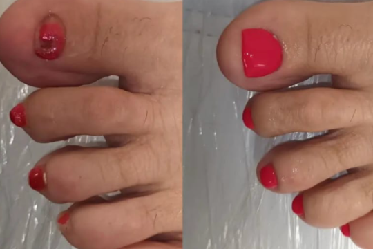 1 uña de gel o reconstrucción micotica