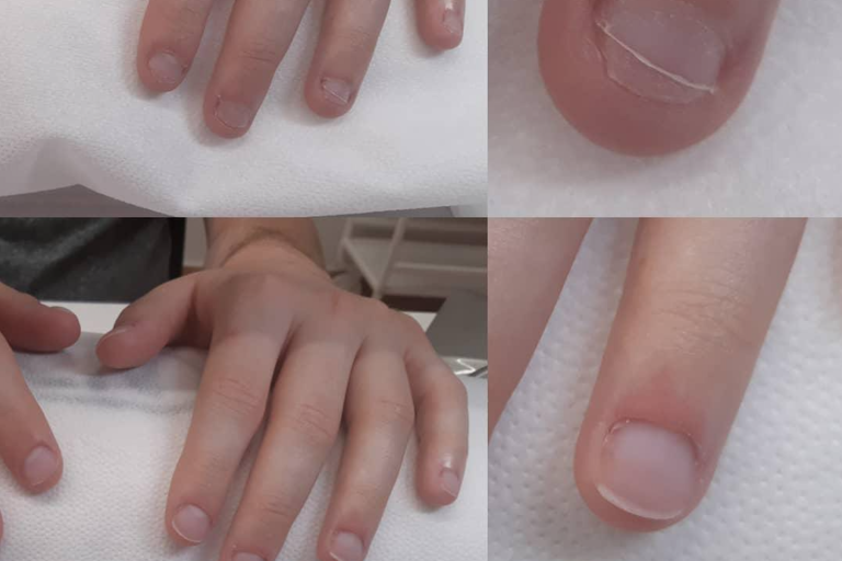 Reconstrucción uñas mordidas